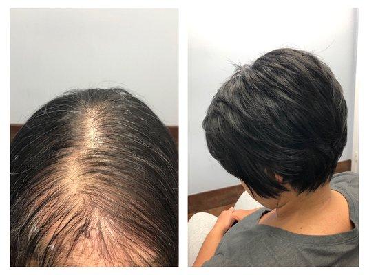 Thinning hair, androgenic alopecia, hair replacement