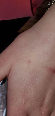 BED BUG BITES