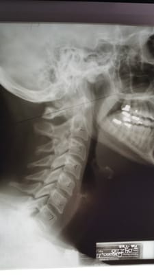 This is a normal lateral cervical spine view. What does your neck look like?