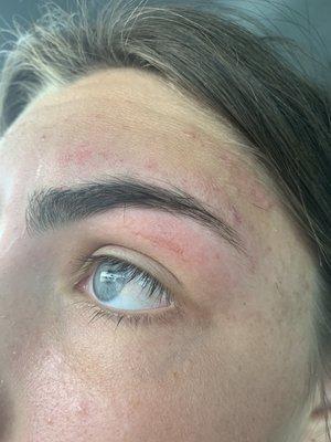 my eyebrow right after it's done and as you can see it's red and my skin is pulled off.