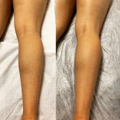 Full leg wax using hard wax by our experienced waxer Cindy