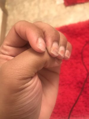 After result of having to get theses thick ass nails removed