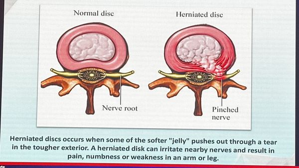 Herniated disc doesn't need surgery