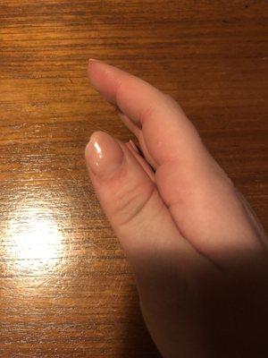 Broken thumb nail (1 day after done)