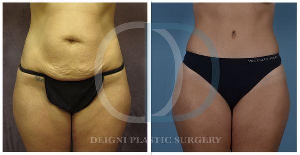 Tummy Tuck