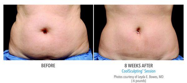 Check out these amazing Coolsculpting results!