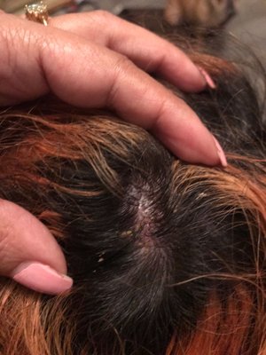 This is the chemical bleach burn on my scalp, after 35 years of experience you would think he wouldn't burn someone's scalp