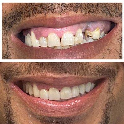 Combination of gum lift, implant and veneers