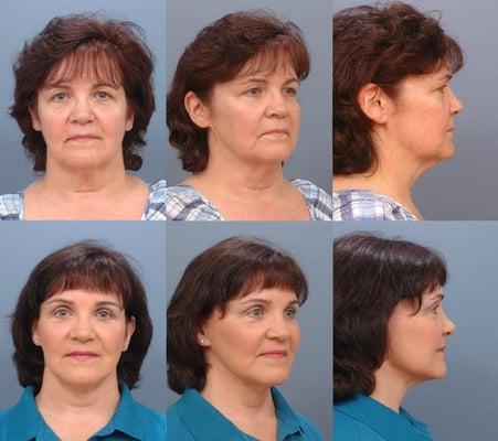 Learn more about facelift surgery http://www.drruas.com/proc_facelift.html