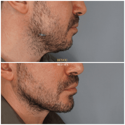 Chin and Jawline Augmentation is one of our greatest specialties