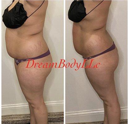 Fat cavitation and Laser Lipo