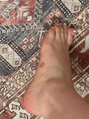 Cut foot during pedicure callus removal