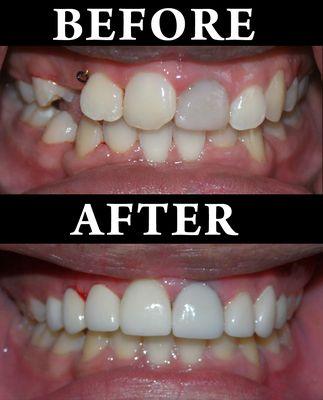 Invisalign and Bridge. Before and after