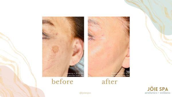 Removal of hyperpigmentation and rosacea due to spider veins at JOIE SPA