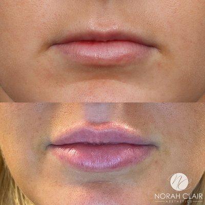 Lip enhancement!