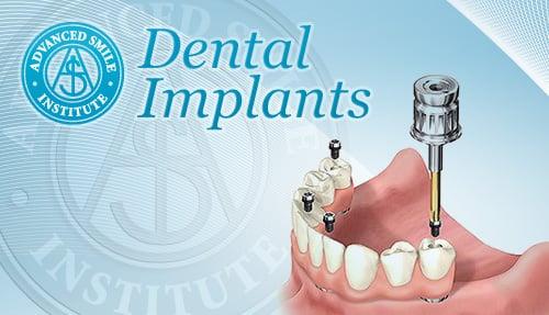 Dental Implants Port St Lucie FL.